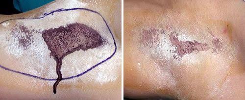 แนะนำเทคนิคดูแลโรคผิวหนัง: ภาวะเหงื่อออกมาก (Hyperhidrosis) คืออะไร & ดูแลได้อย่างไร? แนะนำเทคนิคดูแลโรคผิวหนัง: ภาวะเหงื่อออกมาก (Hyperhidrosis) คืออะไร & ดูแลได้อย่างไร?