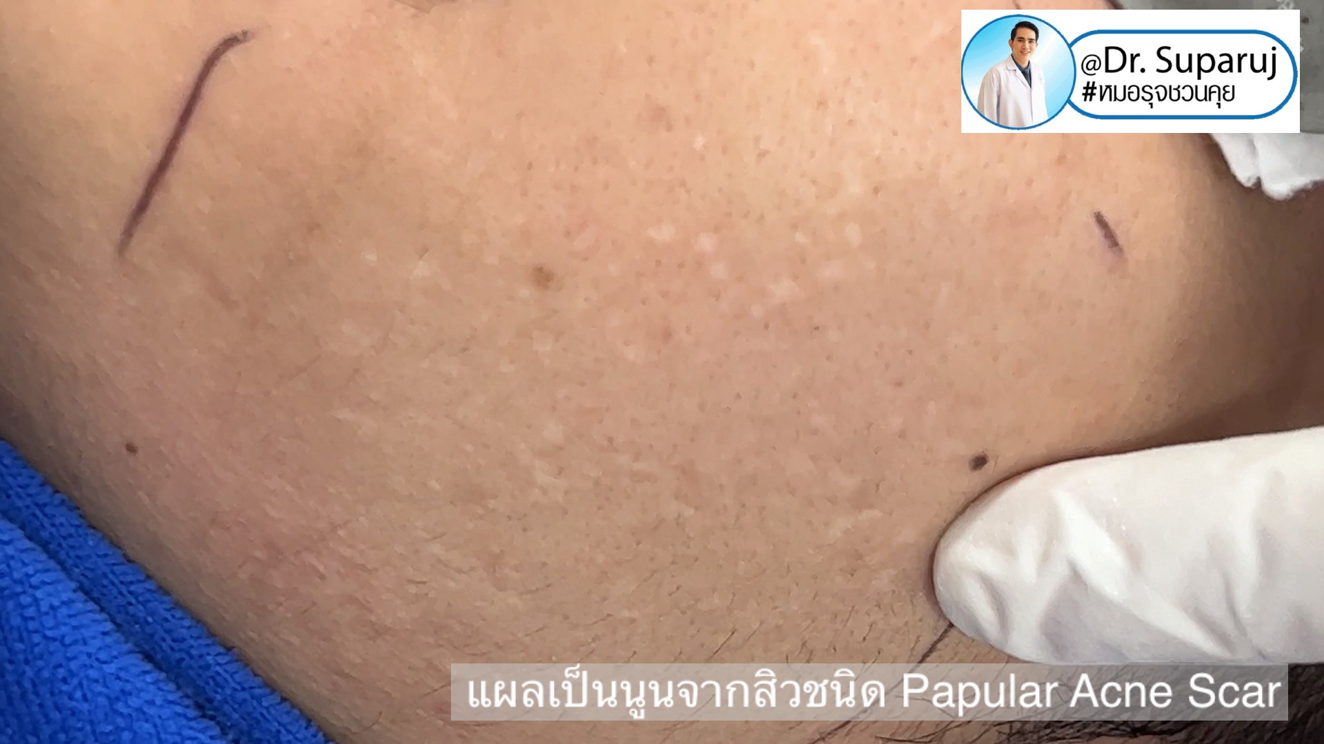 Back to the Basics: หลุมสิวมีกี่ชนิด & มีลักษณะอย่างไร ? Acne Scar Classification Full Clip คลิปเต็ม Facebook/ YouTube Dr. Suparuj หมอรุจชวนคุย ครับ Back to the Basics: หลุมสิวมีกี่ชนิด & มีลักษณะอย่างไร ? Acne Scar Classification Full Clip คลิปเต็ม Facebook/ YouTube Dr. Suparuj หมอรุจชวนคุย ครับ