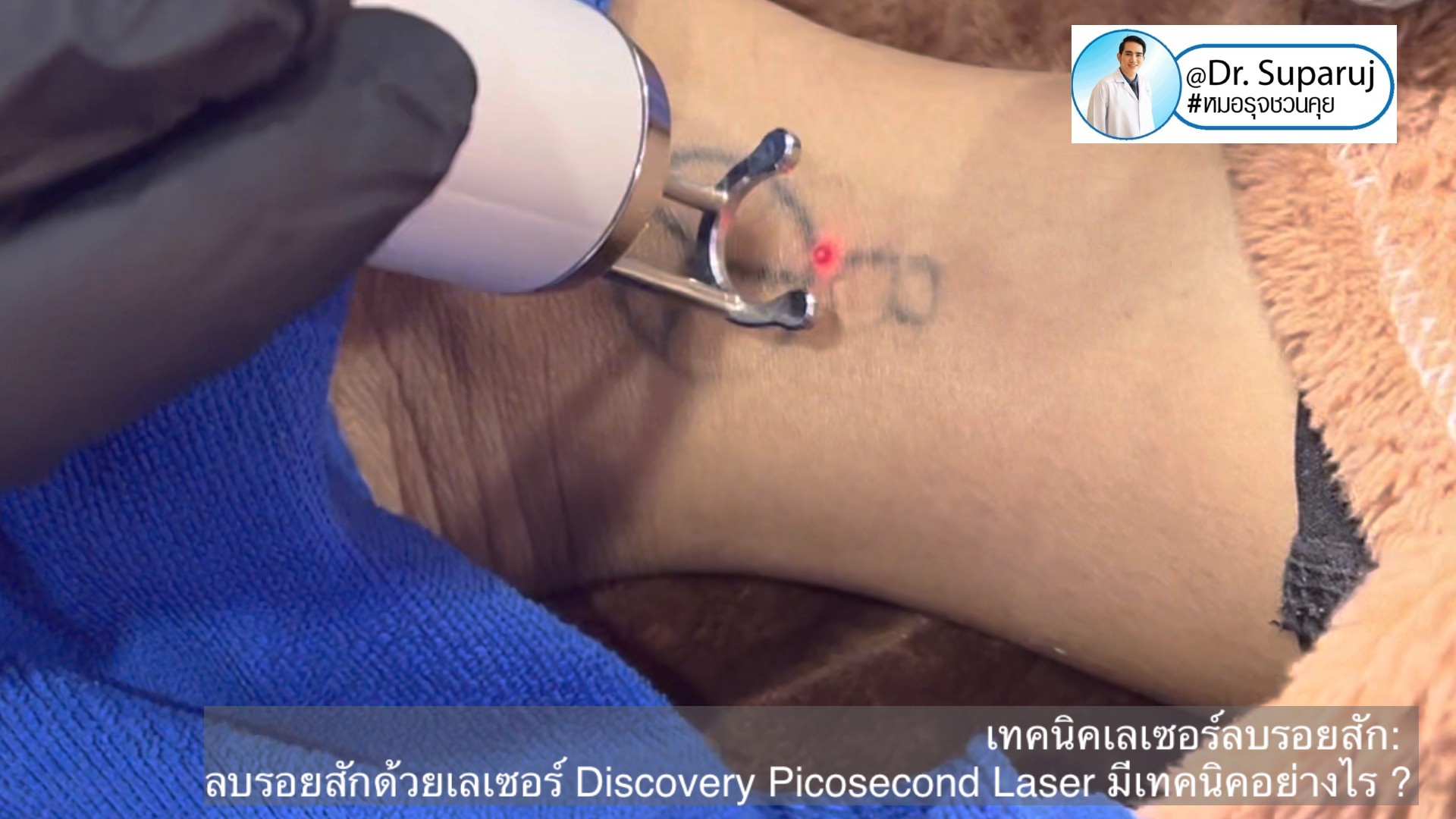 แนะนำเทคนิคเลเซอร์ลบรอยสักด้วย Picosecond Laser: ลบรอยสักด้วยเลเซอร์ Discovery Picosecond Laser มีเทคนิคอย่างไร ?