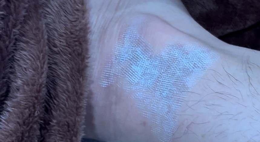 เทคนิคดูแลปานแต่กำเนิดด้วยเลเซอร์ดิสคัฟเวอรี่พิโค Birthmark Treatment with Special Handpieces of Discovery Pico Laser เทคนิคดูแลปานแต่กำเนิดด้วยเลเซอร์ดิสคัฟเวอรี่พิโค Birthmark Treatment with Special Handpieces of Discovery Pico Laser