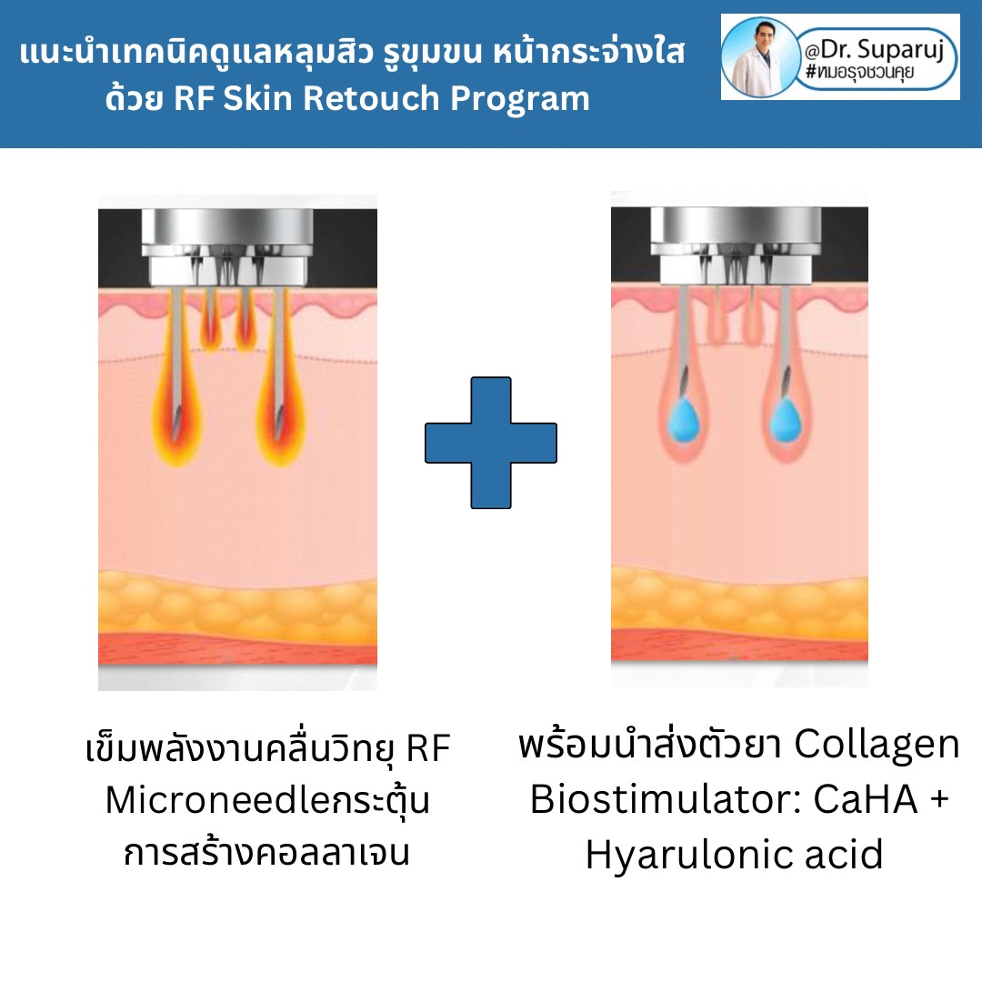 แนะนำเทคนิคดูแลหลุมสิว รูขุมขน หน้ากระจ่างใสด้วย RF Skin Retouch Program แนะนำเทคนิคดูแลหลุมสิว รูขุมขน หน้ากระจ่างใสด้วย RF Skin Retouch Program