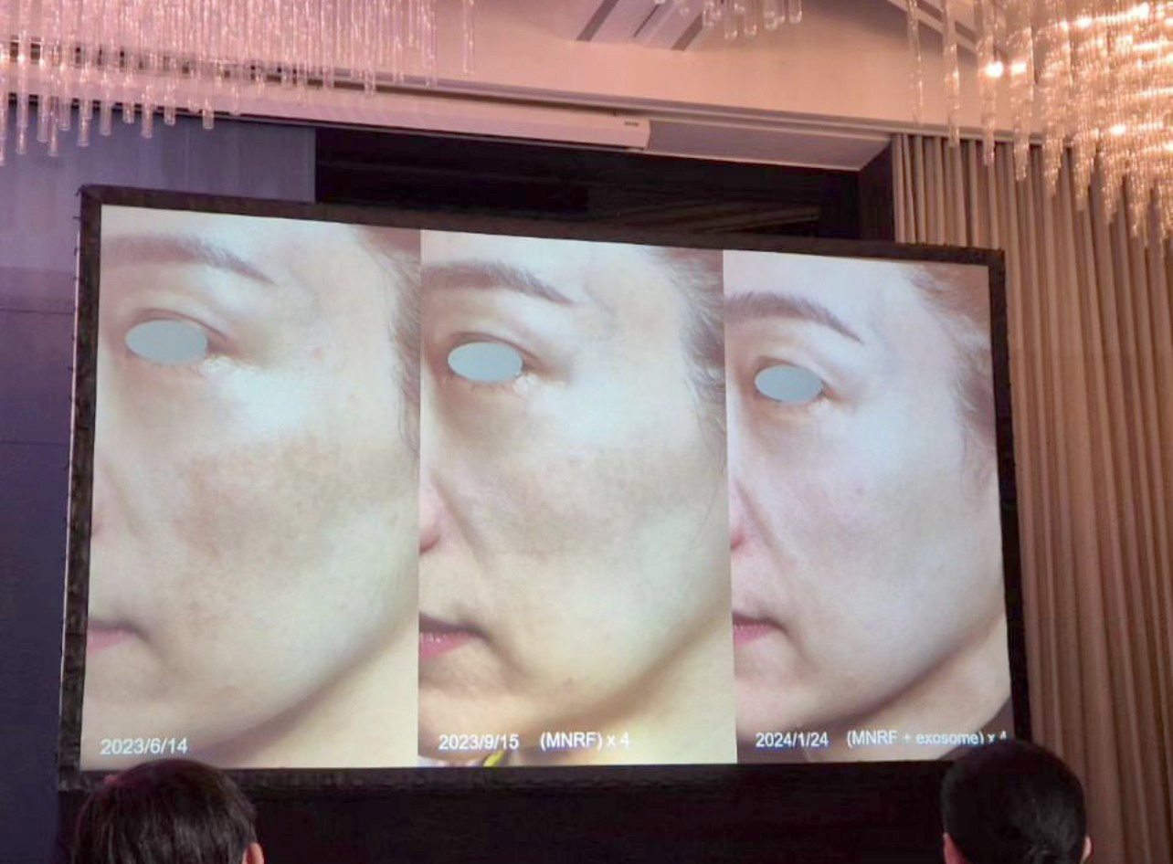 หมอรุจ ผศ. นพ. ศุภะรุจ เลื่องอรุณ ได้รับเกียรติร่วมบรรยายแชร์เทคนิคการดูแลปัญหาผิวหนัง เช่น หลุมสิว แผลเป็น ปัญหาเส้นผม ฝ้า กับแพทย์ผู้เชี่ยวชาญระดับแนวหน้าของประเทศไต้หวัน เช่น หมอรุจ ผศ. นพ. ศุภะรุจ เลื่องอรุณ ได้รับเกียรติร่วมบรรยายแชร์เทคนิคการดูแลปัญหาผิวหนัง เช่น หลุมสิว แผลเป็น ปัญหาเส้นผม ฝ้า กับแพทย์ผู้เชี่ยวชาญระดับแนวหน้าของประเทศไต้หวัน เช่น