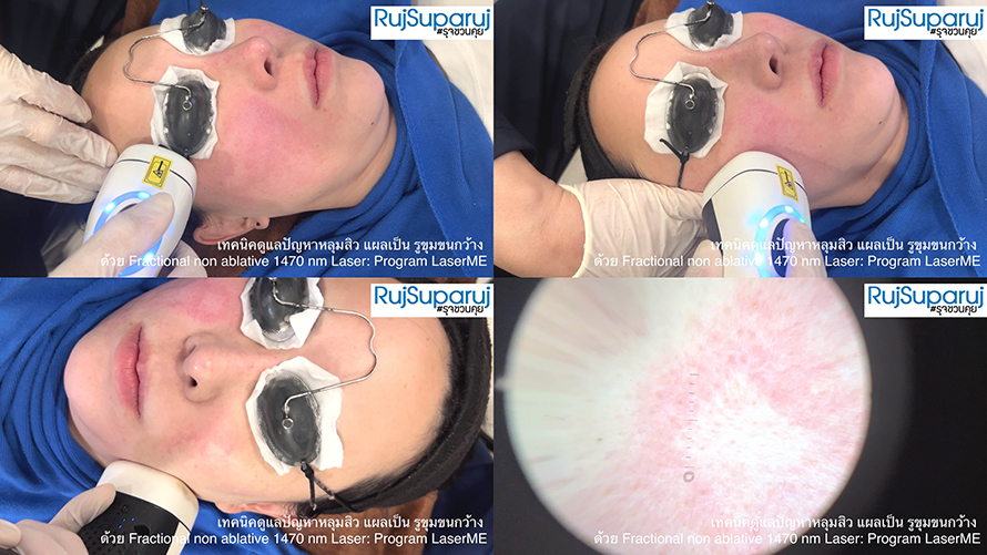 เทคนิคดูแลปัญหาหลุมสิว แผลเป็น รูขุมขนกว้าง ด้วย Fractional non ablative 1470 nm Laser: Program LaserME เทคนิคดูแลปัญหาหลุมสิว แผลเป็น รูขุมขนกว้าง ด้วย Fractional non ablative 1470 nm Laser: Program LaserME