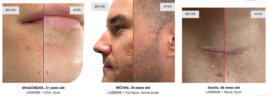 LaserME Program (Fractional Non-Ablative 1470 nm Laser) for acne scars and skin rejuvenation in English: LaserME Program (Fractional Non-Ablative 1470 nm Laser) for acne scars and skin rejuvenation in English: