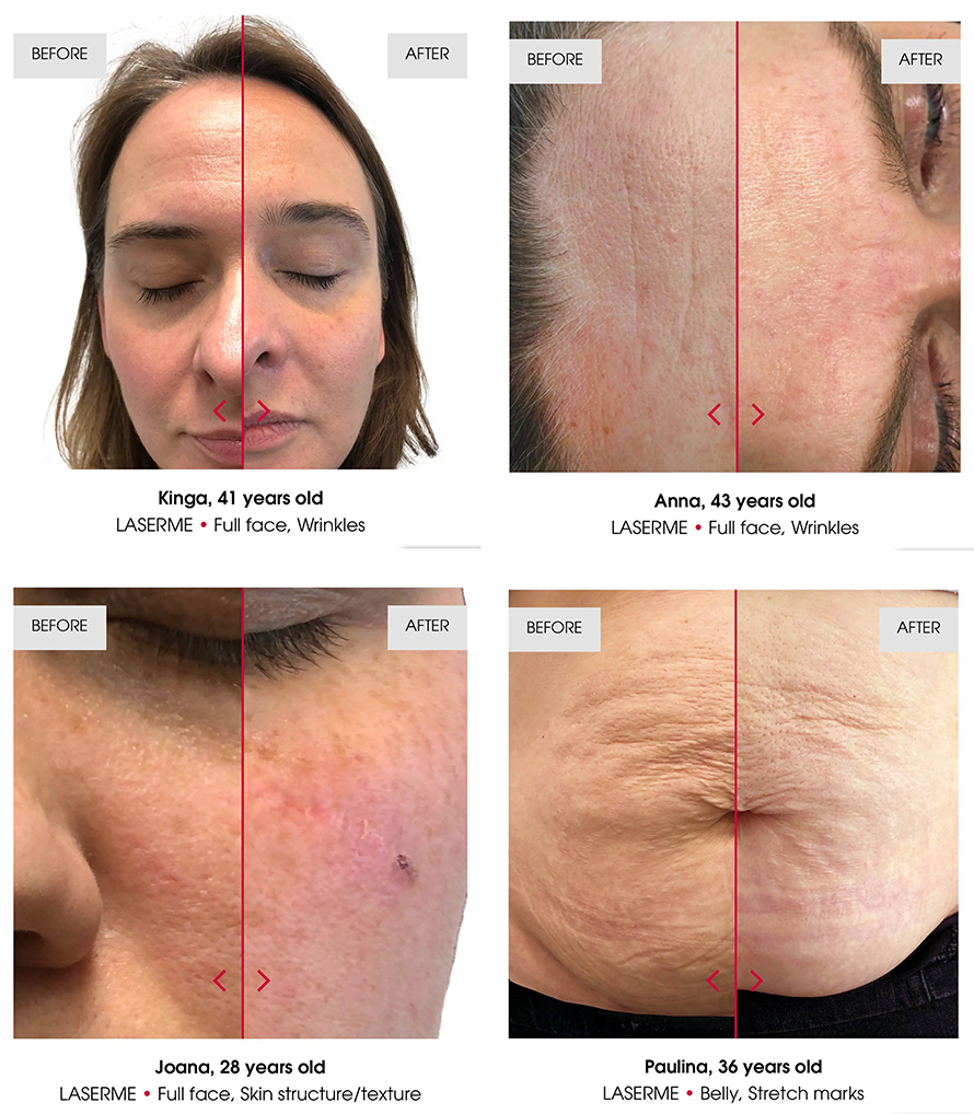 LaserME Program (Fractional Non-Ablative 1470 nm Laser) for acne scars and skin rejuvenation in English:
