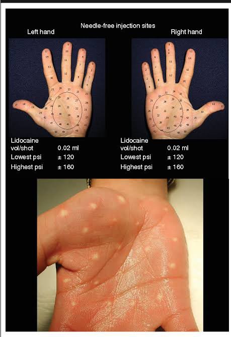 แนะนำเทคนิคดูแลโรคผิวหนัง: ภาวะเหงื่อออกมาก (Hyperhidrosis) คืออะไร & ดูแลได้อย่างไร? แนะนำเทคนิคดูแลโรคผิวหนัง: ภาวะเหงื่อออกมาก (Hyperhidrosis) คืออะไร & ดูแลได้อย่างไร?