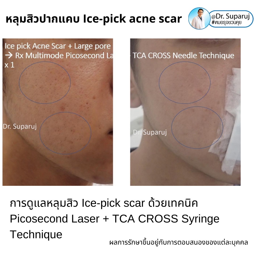  แนะนำเทคนิครักษาหลุมสิวจิกลึก Ice Pick Acne Scar ด้วยเทคนิคเลเซอร์ UltraDeep Pico Technique (Ice Pick Acne Scar Treatment with Discovery Pico Laser + UltraDeep Pico Technique)