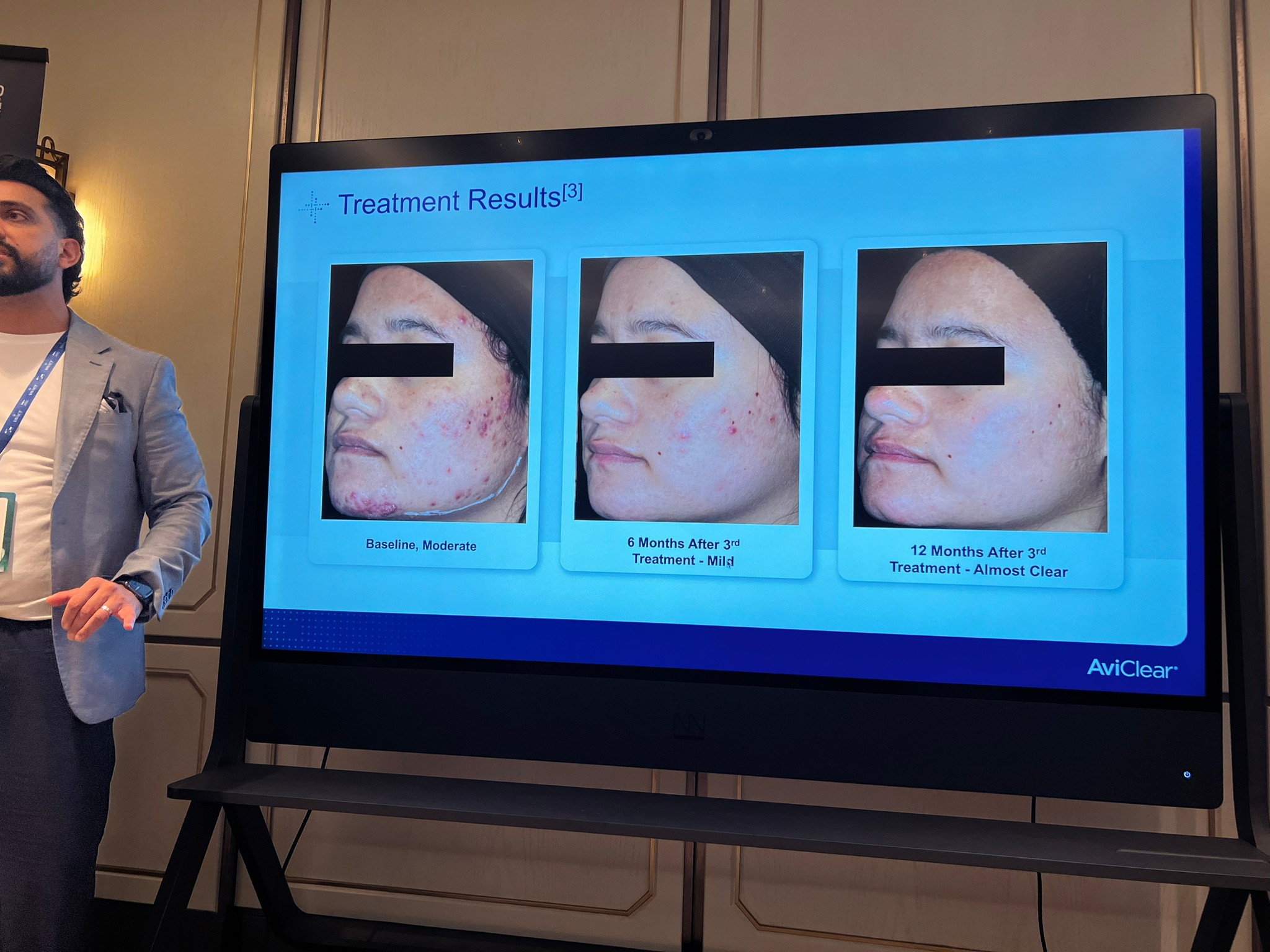 Update เครื่องเลเซอร์สำหรับรักษาสิวโดยเฉพาะ จับกับต่อมไขมันโดยตรง = AviClear 1726 nm Laser Update เครื่องเลเซอร์สำหรับรักษาสิวโดยเฉพาะ จับกับต่อมไขมันโดยตรง = AviClear 1726 nm Laser