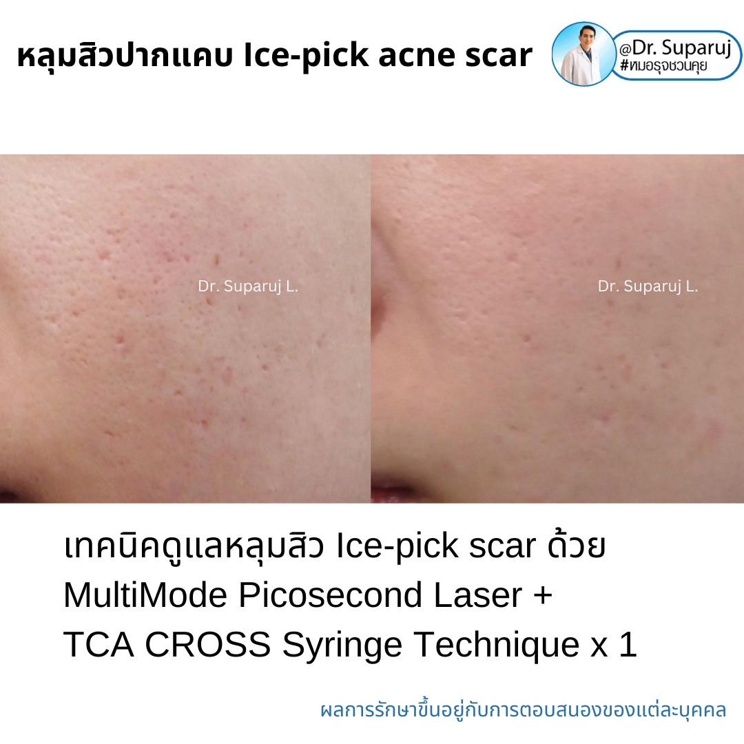 แนะนำเทคนิครักษาหลุมสิวจิกลึก Ice Pick Acne Scar ด้วยเทคนิคเลเซอร์ UltraDeep Pico Technique (Ice Pick Acne Scar Treatment with Discovery Pico Laser + UltraDeep Pico Technique)  แนะนำเทคนิครักษาหลุมสิวจิกลึก Ice Pick Acne Scar ด้วยเทคนิคเลเซอร์ UltraDeep Pico Technique (Ice Pick Acne Scar Treatment with Discovery Pico Laser + UltraDeep Pico Technique)