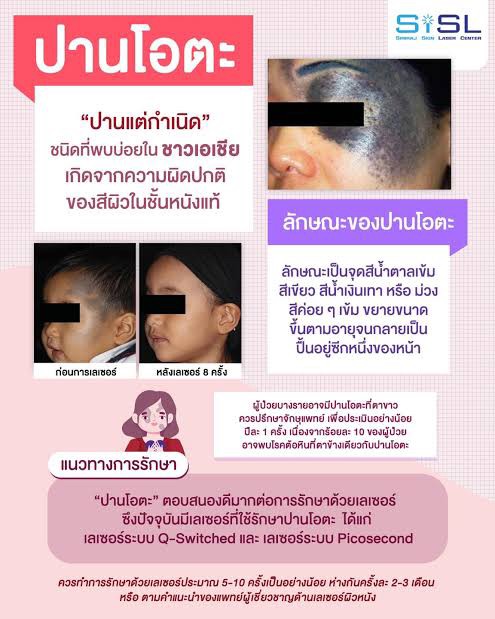เทคนิคดูแลปานแต่กำเนิดด้วยเลเซอร์ดิสคัฟเวอรี่พิโค Birthmark Treatment with Special Handpieces of Discovery Pico Laser เทคนิคดูแลปานแต่กำเนิดด้วยเลเซอร์ดิสคัฟเวอรี่พิโค Birthmark Treatment with Special Handpieces of Discovery Pico Laser