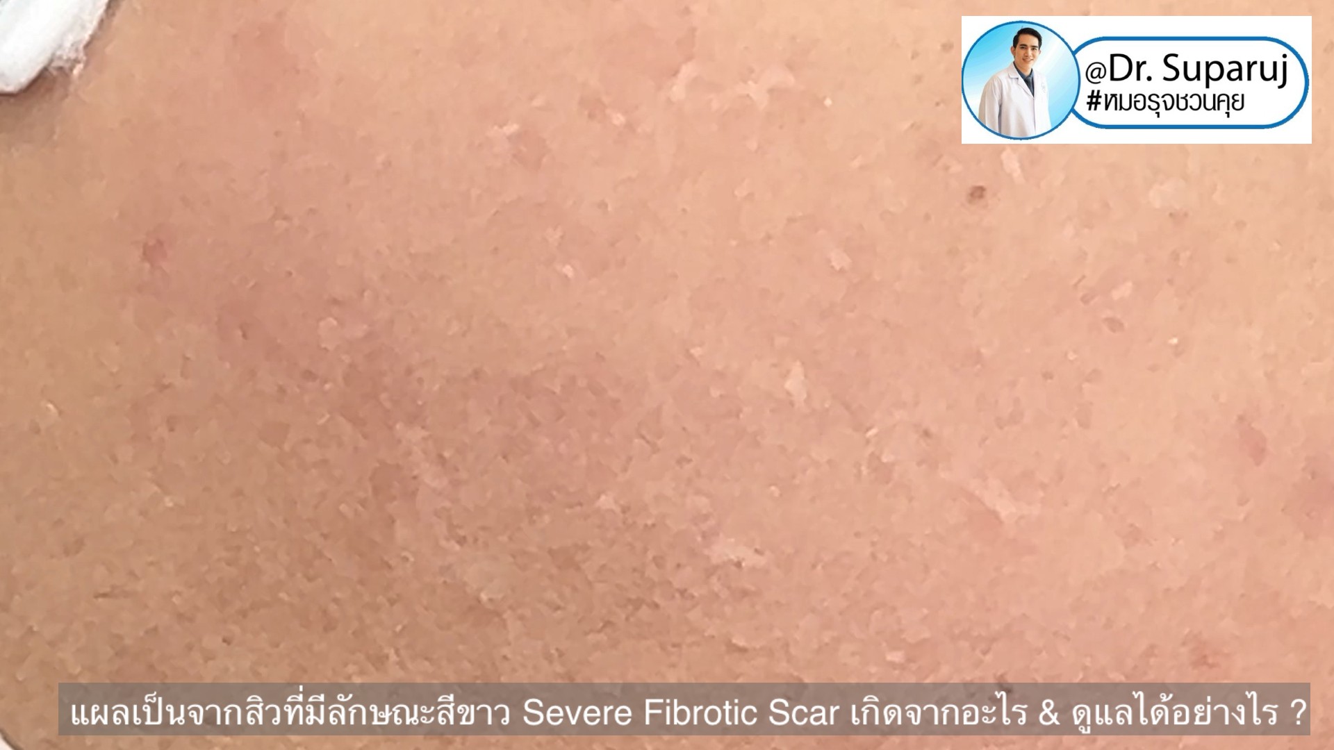 แผลเป็นจากสิวที่มีลักษณะสีขาว severe fibrotic acne scar เกิดจากอะไร & ดูแลได้อย่างไร ? แผลเป็นจากสิวที่มีลักษณะสีขาว severe fibrotic acne scar เกิดจากอะไร & ดูแลได้อย่างไร ?