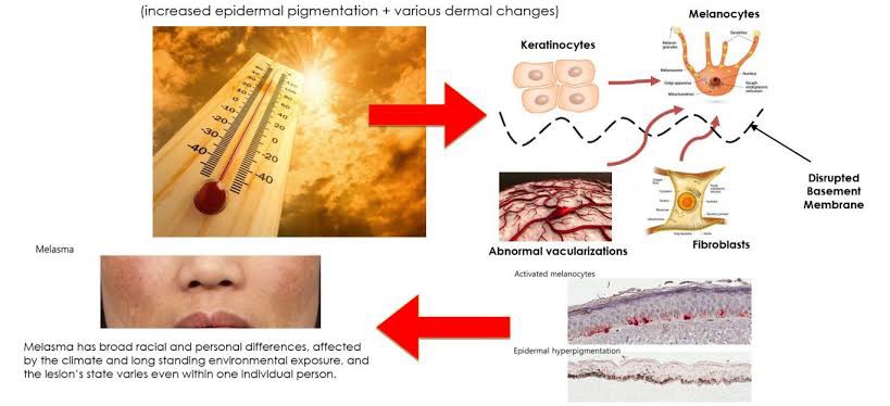 Update Concept ใหม่ในการรักษาฝ้า ด้วยการฟื้นฟูผิวด้วยการใช้ เข็มพลังงานคลื่นวิทยุ + Exosomes (SylfirmX Plus Fractional RF MicroNeedle + Exosomes for Melasma Skin Rehabilitation) Update Concept ใหม่ในการรักษาฝ้า ด้วยการฟื้นฟูผิวด้วยการใช้ เข็มพลังงานคลื่นวิทยุ + Exosomes (SylfirmX Plus Fractional RF MicroNeedle + Exosomes for Melasma Skin Rehabilitation)