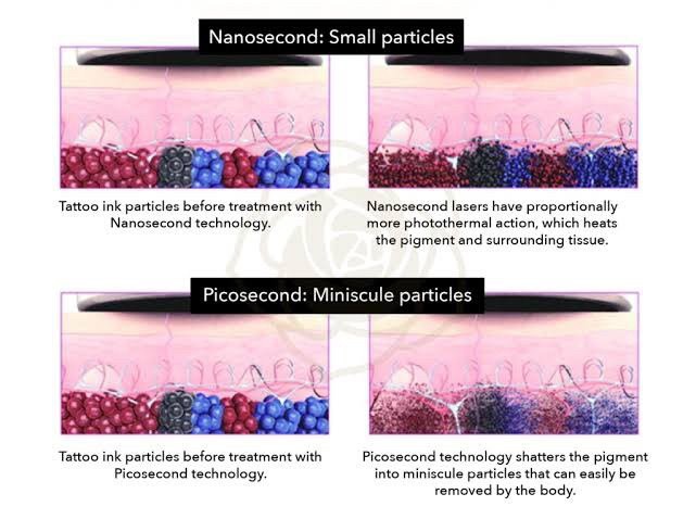 แนะนำเทคนิคเลเซอร์ลบรอยสักด้วย Picosecond Laser: ลบรอยสักด้วยเลเซอร์ Discovery Picosecond Laser มีเทคนิคอย่างไร ? แนะนำเทคนิคเลเซอร์ลบรอยสักด้วย Picosecond Laser: ลบรอยสักด้วยเลเซอร์ Discovery Picosecond Laser มีเทคนิคอย่างไร ?