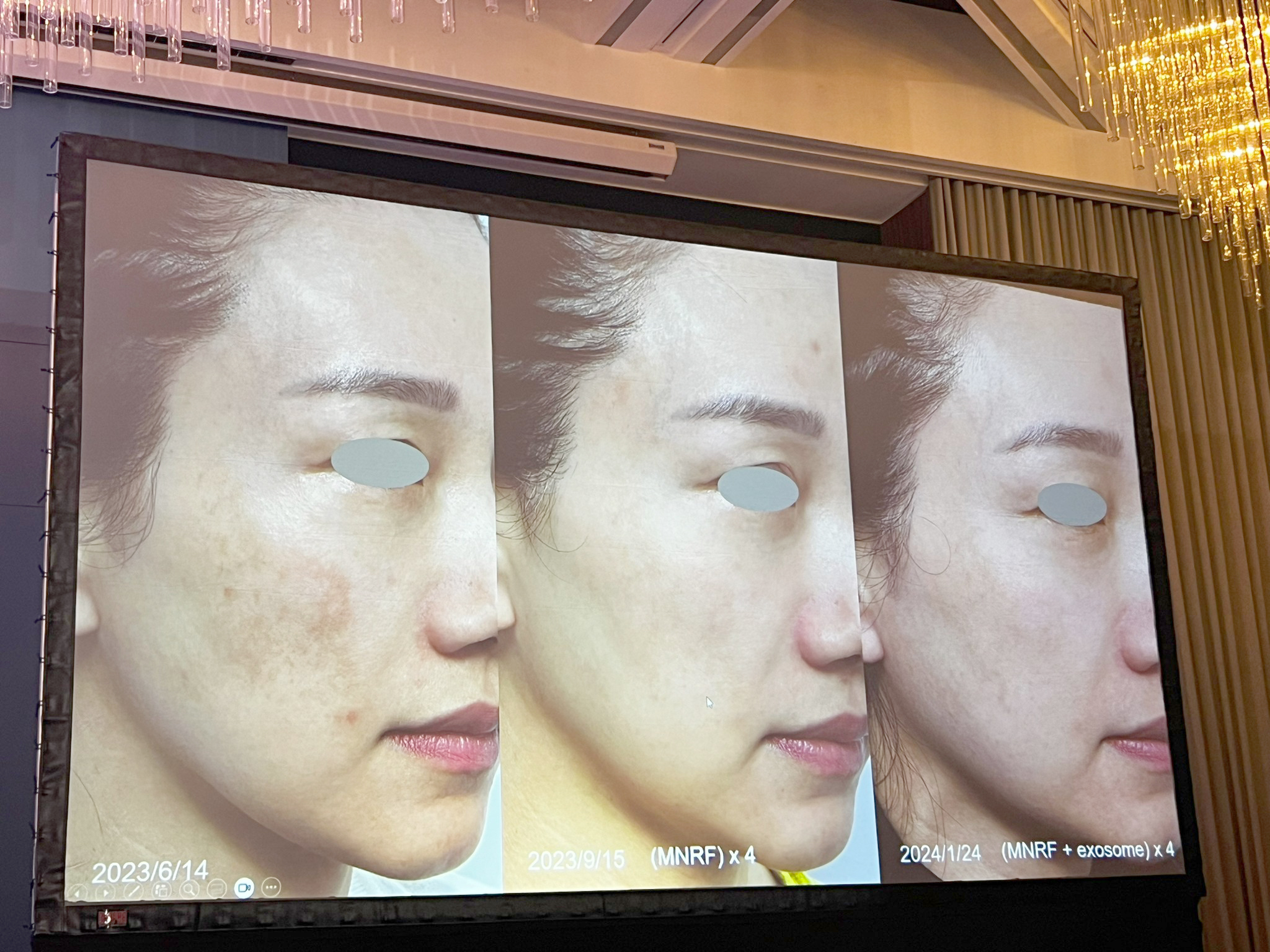 หมอรุจ ผศ. นพ. ศุภะรุจ เลื่องอรุณ ได้รับเกียรติร่วมบรรยายแชร์เทคนิคการดูแลปัญหาผิวหนัง เช่น หลุมสิว แผลเป็น ปัญหาเส้นผม ฝ้า กับแพทย์ผู้เชี่ยวชาญระดับแนวหน้าของประเทศไต้หวัน เช่น หมอรุจ ผศ. นพ. ศุภะรุจ เลื่องอรุณ ได้รับเกียรติร่วมบรรยายแชร์เทคนิคการดูแลปัญหาผิวหนัง เช่น หลุมสิว แผลเป็น ปัญหาเส้นผม ฝ้า กับแพทย์ผู้เชี่ยวชาญระดับแนวหน้าของประเทศไต้หวัน เช่น