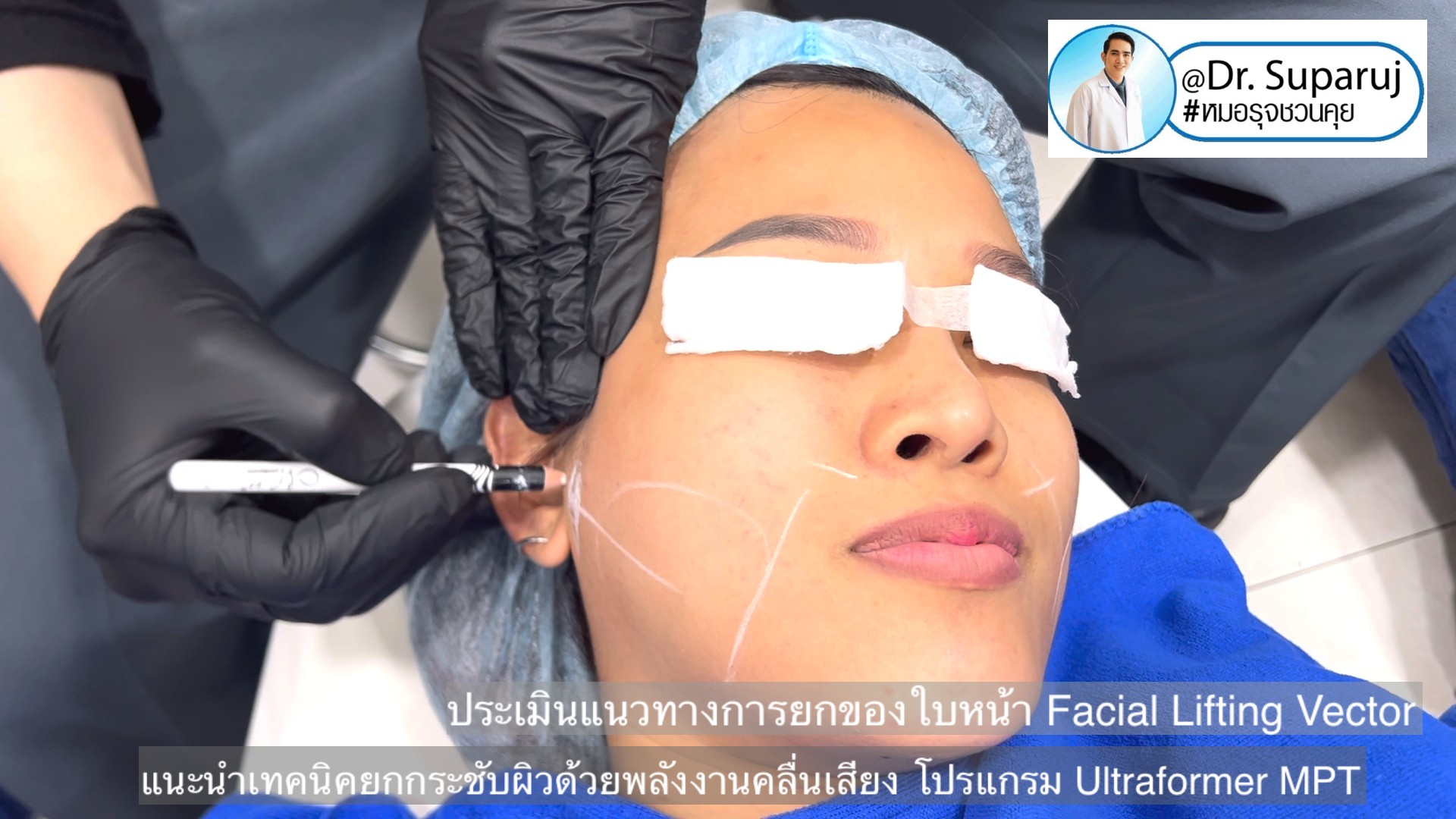 แนะนำเทคนิคยกกระชับผิว ด้วยพลังงานคลื่นเสียง MMFU Focused Ultrasound โปรแกรม Ultraformer MPT แนะนำเทคนิคยกกระชับผิว ด้วยพลังงานคลื่นเสียง MMFU Focused Ultrasound โปรแกรม Ultraformer MPT