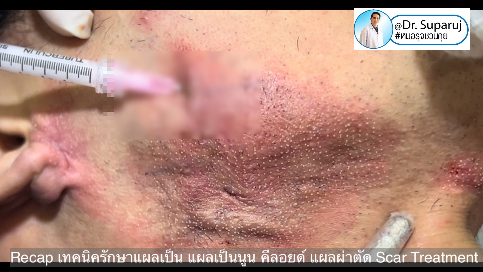 Recap เทคนิครักษาแผลเป็น แผลเป็นนูน คีลอยด์ แผลผ่าตัด Scar Treatment