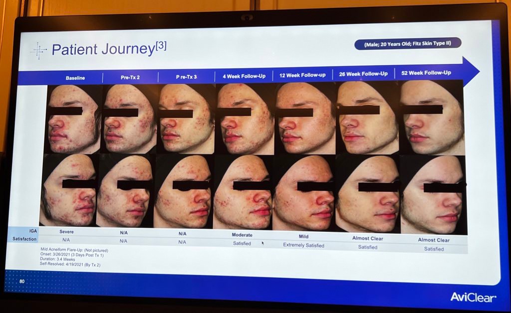 Update เครื่องเลเซอร์สำหรับรักษาสิวโดยเฉพาะ จับกับต่อมไขมันโดยตรง = AviClear 1726 nm Laser Update เครื่องเลเซอร์สำหรับรักษาสิวโดยเฉพาะ จับกับต่อมไขมันโดยตรง = AviClear 1726 nm Laser