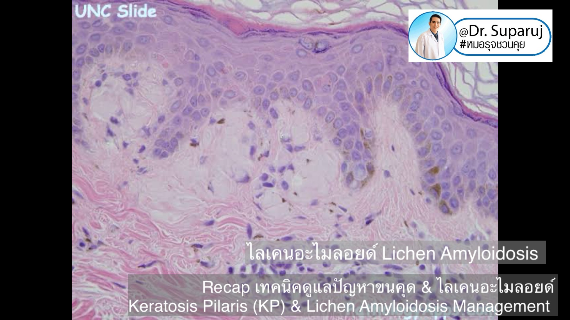 Recap เทคนิคดูแลปัญหาขนคุด & ไลเคนอะไมลอยด์  Keratosis Pilaris (KP) & Lichen Amyloidosis Management