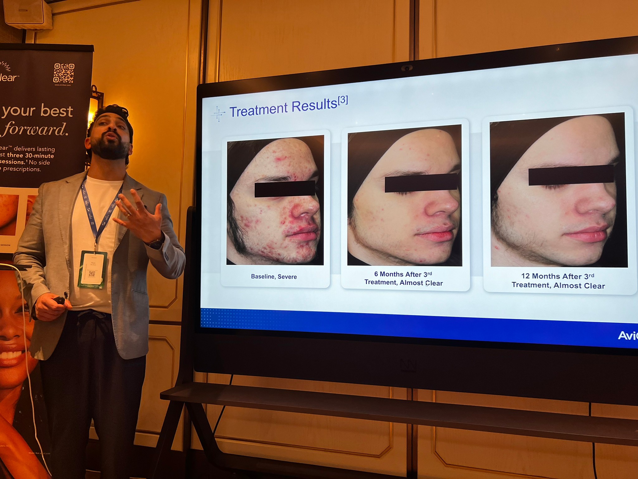 Update เครื่องเลเซอร์สำหรับรักษาสิวโดยเฉพาะ จับกับต่อมไขมันโดยตรง = AviClear 1726 nm Laser Update เครื่องเลเซอร์สำหรับรักษาสิวโดยเฉพาะ จับกับต่อมไขมันโดยตรง = AviClear 1726 nm Laser