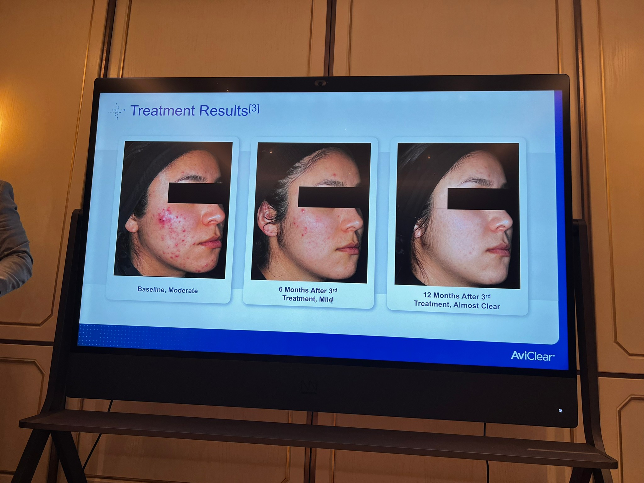 Update เครื่องเลเซอร์สำหรับรักษาสิวโดยเฉพาะ จับกับต่อมไขมันโดยตรง = AviClear 1726 nm Laser Update เครื่องเลเซอร์สำหรับรักษาสิวโดยเฉพาะ จับกับต่อมไขมันโดยตรง = AviClear 1726 nm Laser