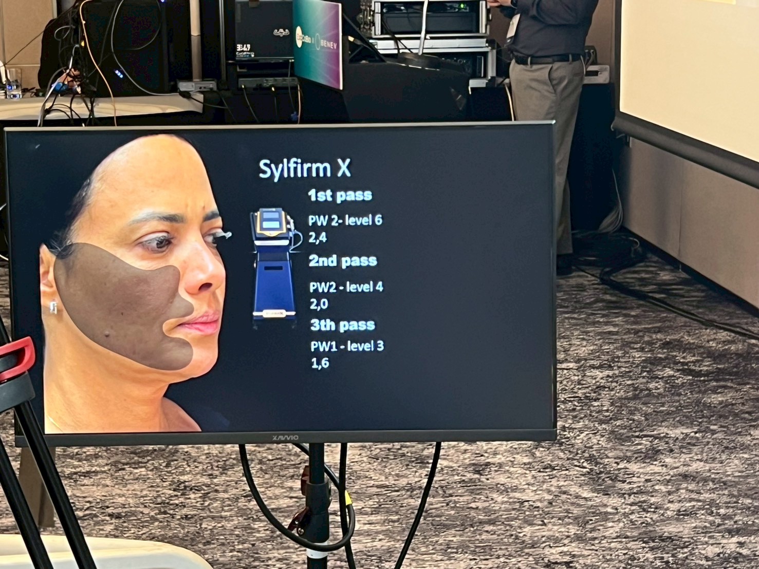 Program Sylfirm X Plus RF Microneedle Live Demonstration at RAES 2025 conference in Seoul, Korea Program Sylfirm X Plus RF Microneedle Live Demonstration at RAES 2025 conference in Seoul, Korea