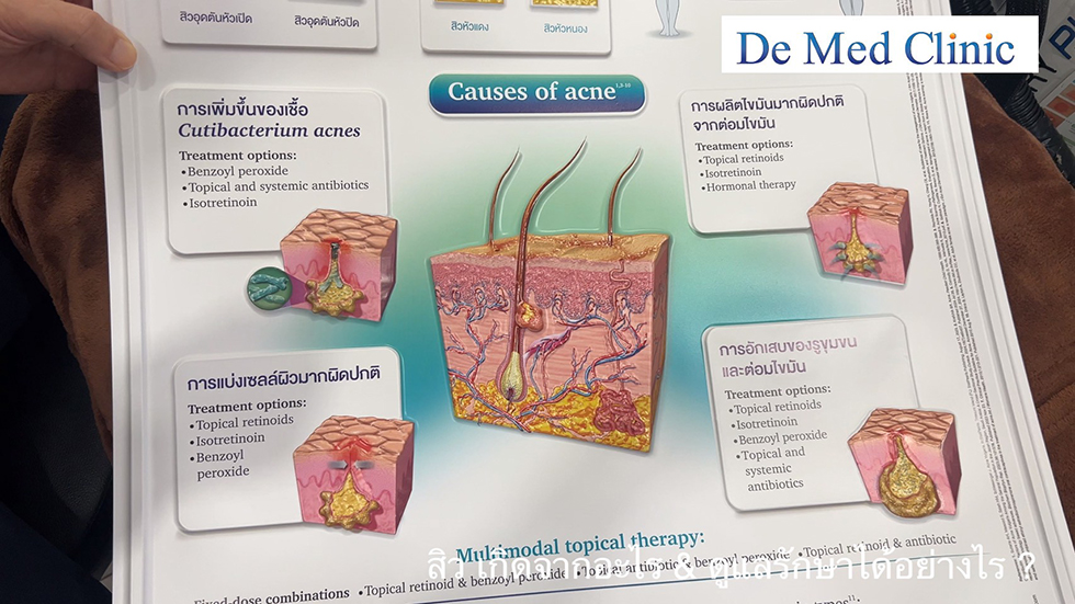 สิว เกิดจากอะไร & ดูแลรักษาได้อย่างไร ? สิว เกิดจากอะไร & ดูแลรักษาได้อย่างไร ?