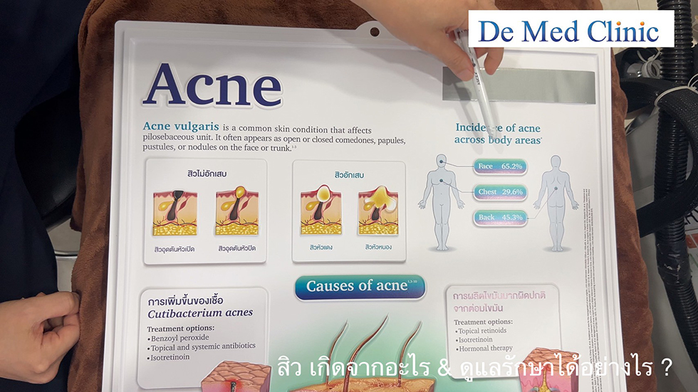 สิวไม่อักเสบ