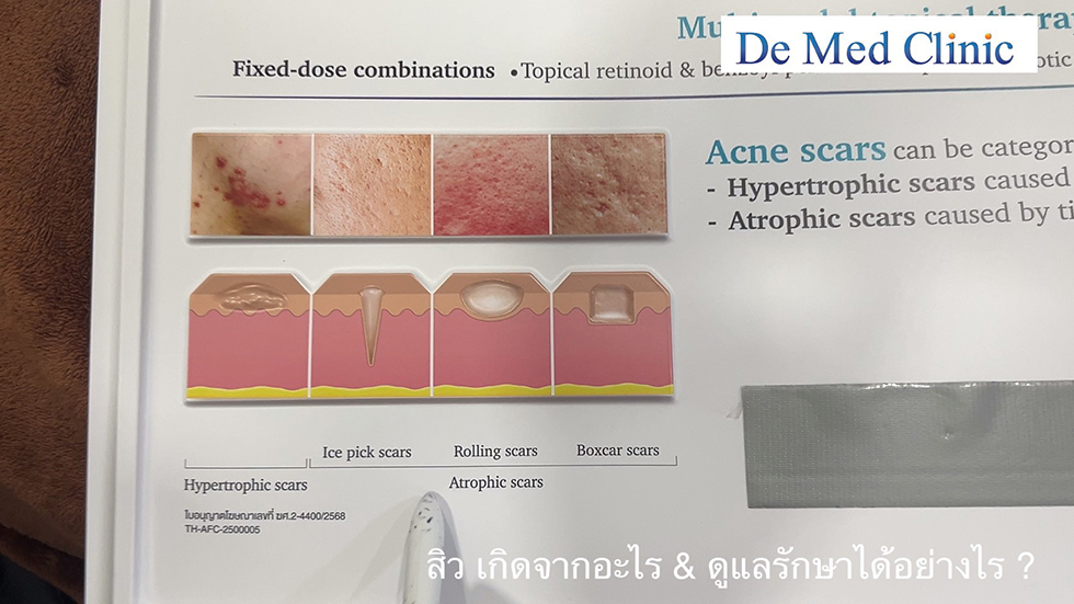 สิว มีวิธีการรักษาอย่างไร? สิว มีวิธีการรักษาอย่างไร?