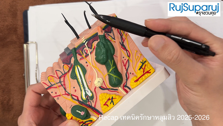 Recap เทคนิครักษาหลุมสิว 2025-20