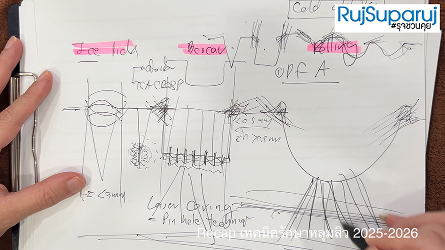 Recap เทคนิครักษาหลุมสิว 2025-20