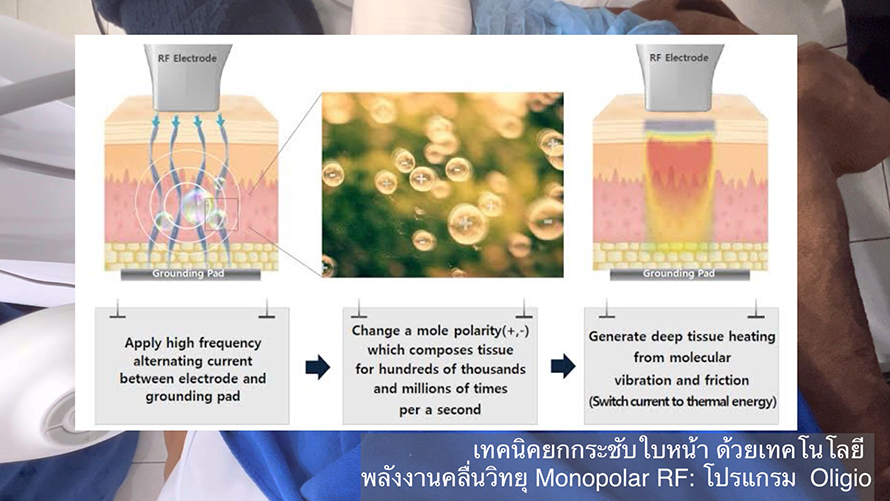 โปรแกรม Oligio แนะนำเทคโนโลยีการยกกระชับใบหน้าด้วย Monopolar RF (Radio Frequency) โดยใช้โปรแกรม Oligio โดยมีประเด็นสำคัญสรุปได้ดังนี้ครับ: โปรแกรม Oligio แนะนำเทคโนโลยีการยกกระชับใบหน้าด้วย Monopolar RF (Radio Frequency) โดยใช้โปรแกรม Oligio โดยมีประเด็นสำคัญสรุปได้ดังนี้ครับ: