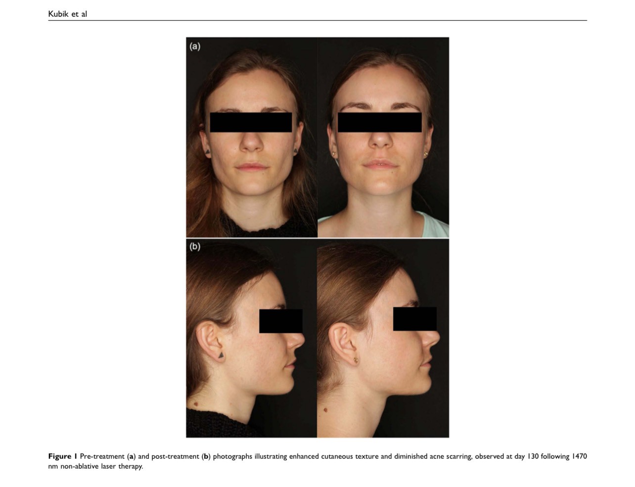 Techniques for managing acne scars, textural scarring, and enlarged pores with a Fractional Non-Ablative 1470-nm Laser: LaserME Program Techniques for managing acne scars, textural scarring, and enlarged pores with a Fractional Non-Ablative 1470-nm Laser: LaserME Program