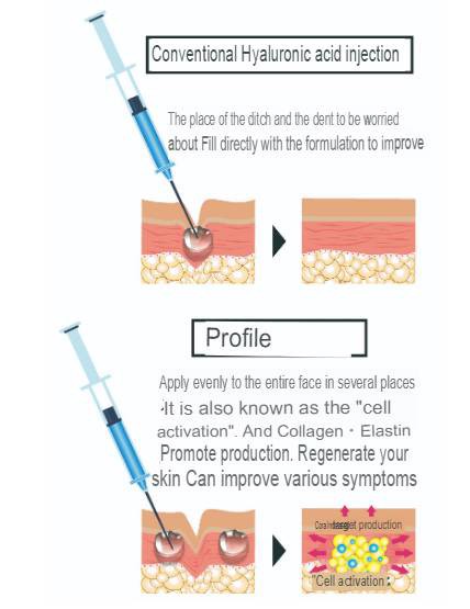 เทคนิครักษาหลุมสิว ด้วยการตัดพังผืดหลุมสิวเทคนิค Program Profhilo Bio-Remodeling Fanning Subcision Techniques for Acne Scar Treatment เทคนิครักษาหลุมสิว ด้วยการตัดพังผืดหลุมสิวเทคนิค Program Profhilo Bio-Remodeling Fanning Subcision Techniques for Acne Scar Treatment