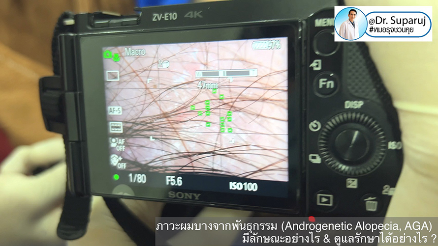 แนวทางการวินิจฉัยและรักษาภาวะผมบางจากพันธุกรรม (Androgenetic Alopecia) แนวทางการวินิจฉัยและรักษาภาวะผมบางจากพันธุกรรม (Androgenetic Alopecia)