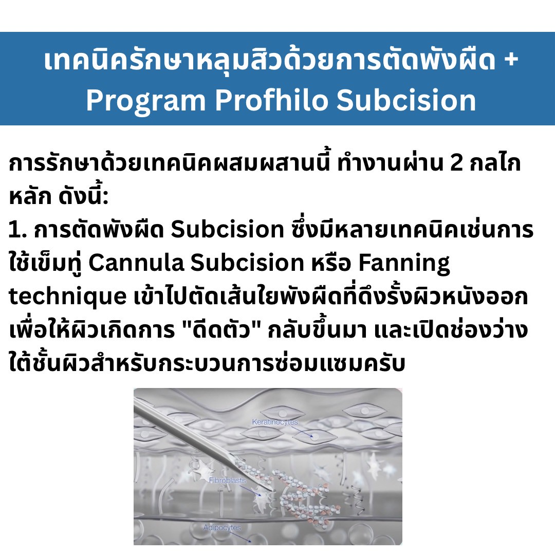 เทคนิครักษาหลุมสิว ด้วยการตัดพังผืดหลุมสิวเทคนิค Program Profhilo Bio-Remodeling Fanning Subcision Techniques for Acne Scar Treatment
