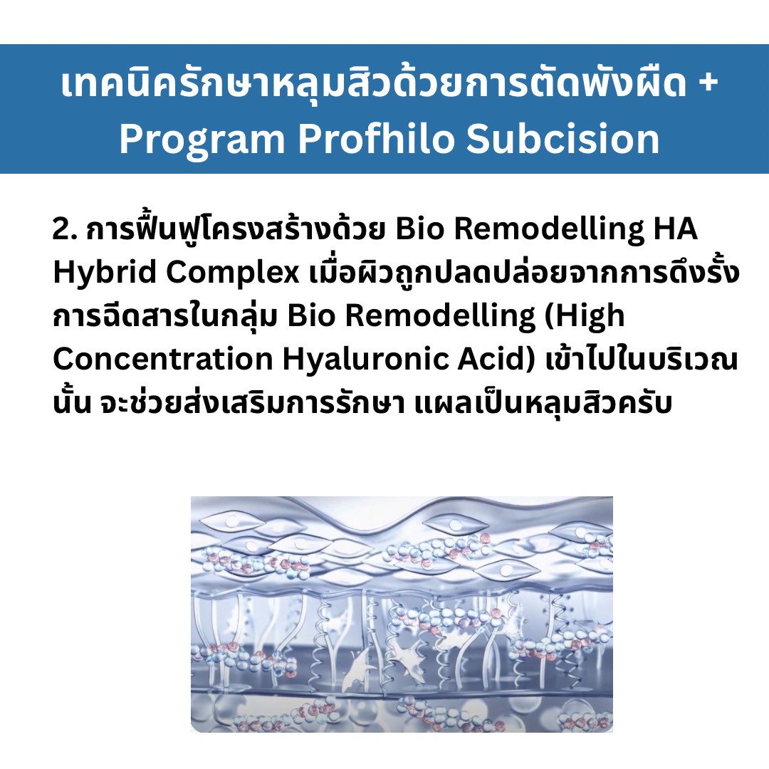 เทคนิครักษาหลุมสิว ด้วยการตัดพังผืดหลุมสิวเทคนิค Program Profhilo Bio-Remodeling Fanning Subcision Techniques for Acne Scar Treatment