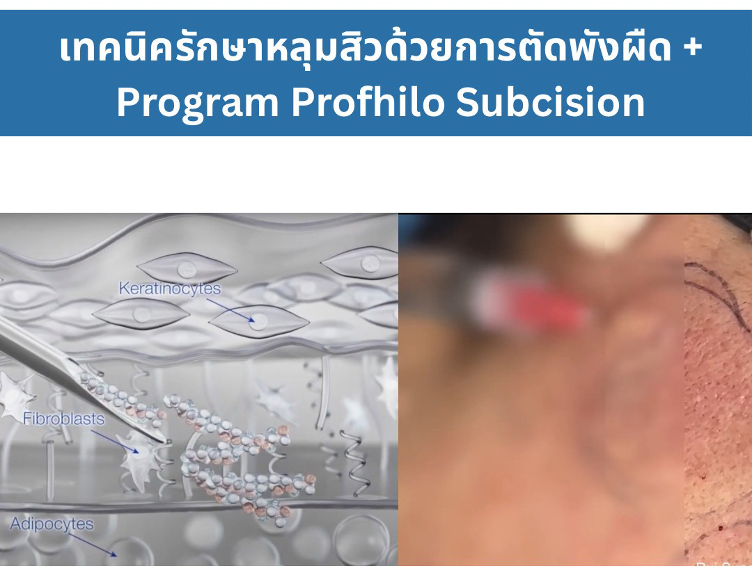 การทำงานของ Program Profhilo * เมื่อฉีดเข้าสู่ผิวแล้ว Program Profhilo จะส่งสัญญาณกระตุ้นเซลล์ไฟโบรบลาสต์ (Fibroblast) ให้ผลิตสร้างคอลลาเจน (ชนิดที่ 1,3 และ 4) รวมถึงอีลาสตินและสารเคลือบเซลล์ การทำงานของ Program Profhilo * เมื่อฉีดเข้าสู่ผิวแล้ว Program Profhilo จะส่งสัญญาณกระตุ้นเซลล์ไฟโบรบลาสต์ (Fibroblast) ให้ผลิตสร้างคอลลาเจน (ชนิดที่ 1,3 และ 4) รวมถึงอีลาสตินและสารเคลือบเซลล์