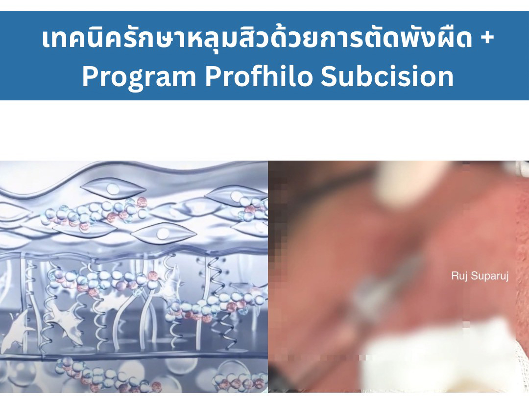 การทำงานของ Program Profhilo * เมื่อฉีดเข้าสู่ผิวแล้ว Program Profhilo จะส่งสัญญาณกระตุ้นเซลล์ไฟโบรบลาสต์ (Fibroblast) ให้ผลิตสร้างคอลลาเจน (ชนิดที่ 1,3 และ 4) รวมถึงอีลาสตินและสารเคลือบเซลล์