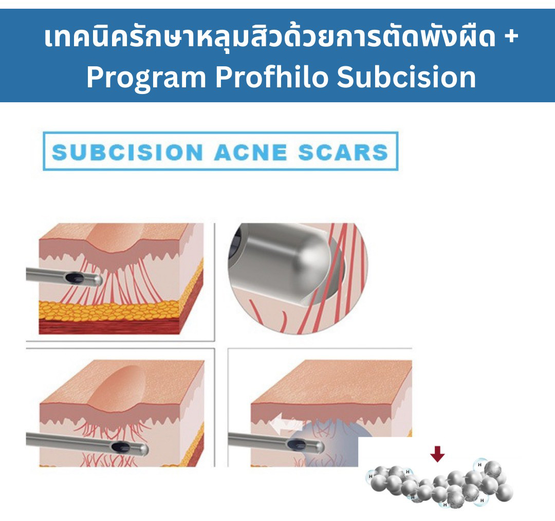 เทคนิครักษาหลุมสิว ด้วยการตัดพังผืดหลุมสิวเทคนิค Program Bio-Remodelling HA Hybrid Complex Fanning Subcision Techniques for Acne Scar Treatment