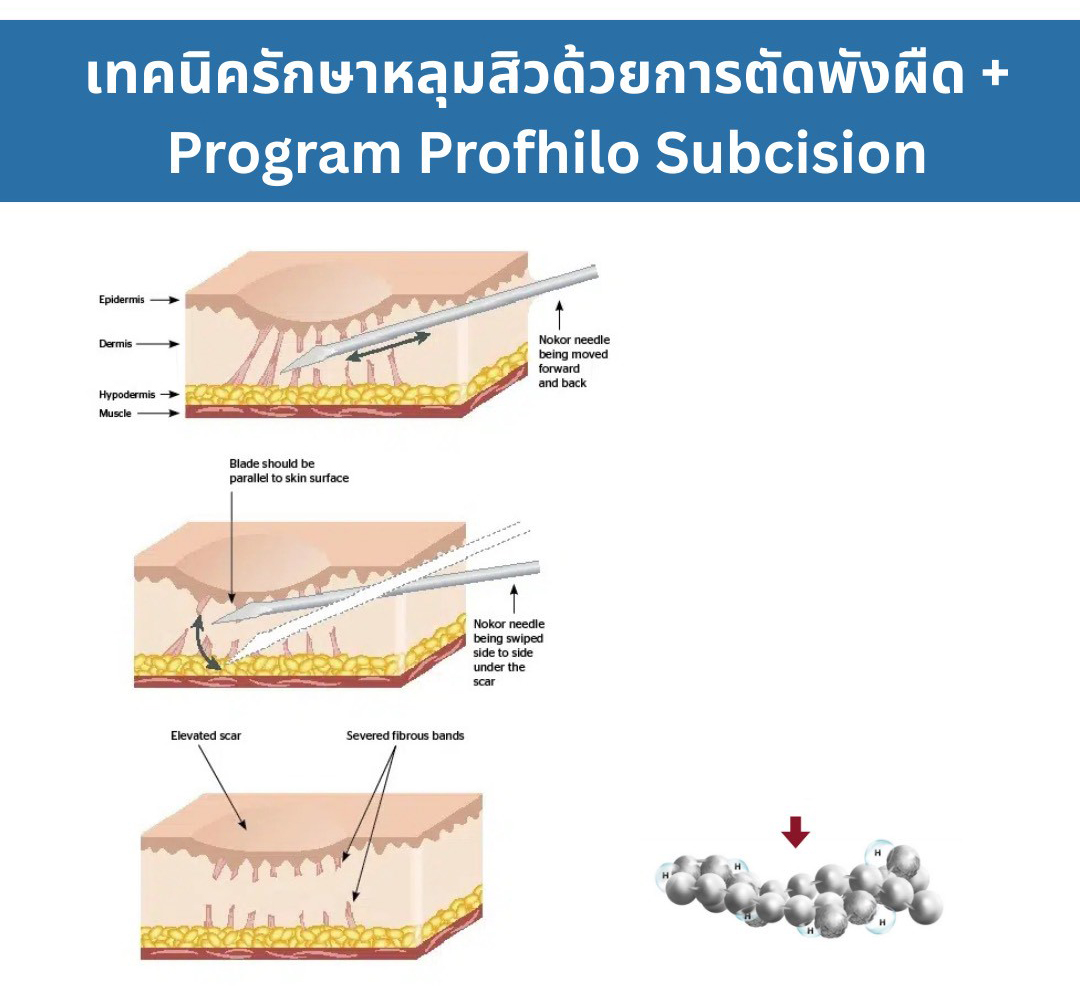 เทคนิครักษาหลุมสิว ด้วยการตัดพังผืดหลุมสิวเทคนิค Program Bio-Remodelling HA Hybrid Complex Fanning Subcision Techniques for Acne Scar Treatment