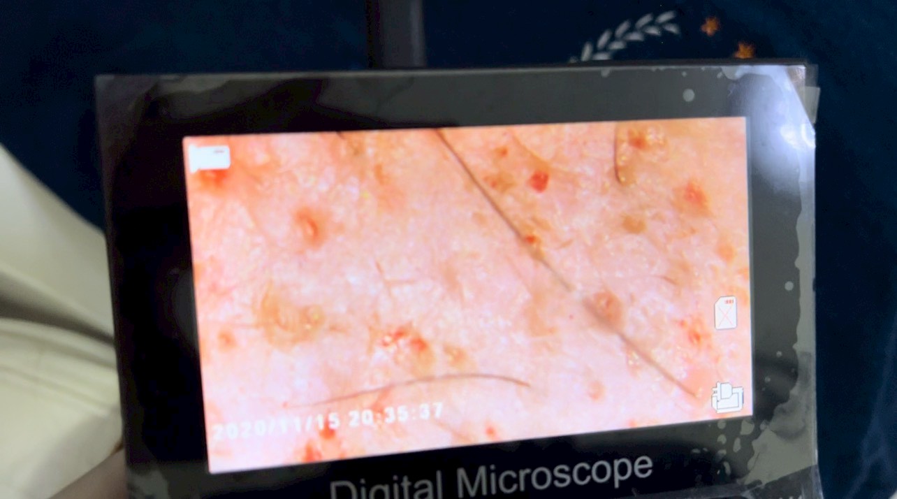 รักษาหลุมสิว แต่ไม่สะดวกมารับการรักษาทุกเดือน จะรักษาได้ผลหรือไม่ ? Can Acne Scars Be Effectively Treated Without Monthly Sessions? รักษาหลุมสิว แต่ไม่สะดวกมารับการรักษาทุกเดือน จะรักษาได้ผลหรือไม่ ? Can Acne Scars Be Effectively Treated Without Monthly Sessions?