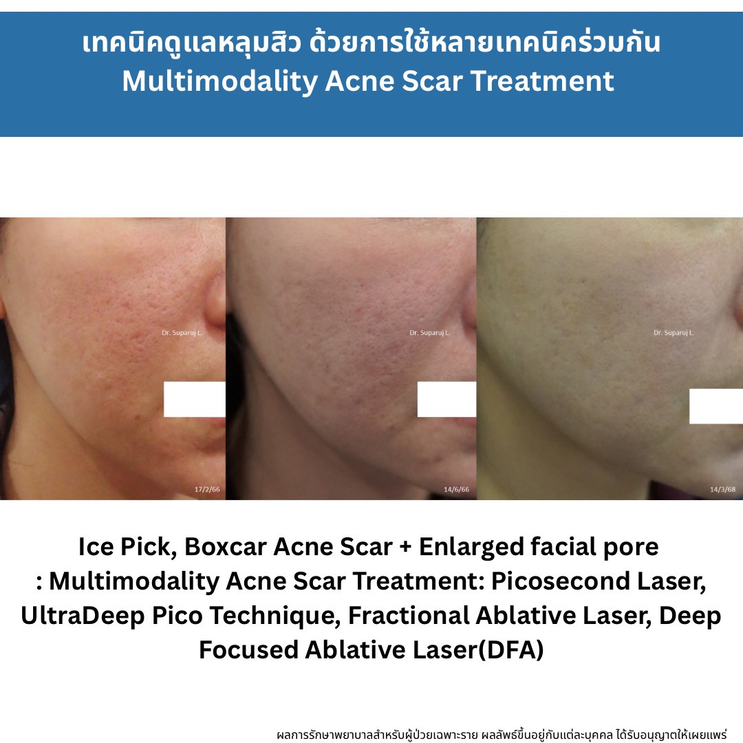 ทำไมต้องใช้เลเซอร์หลายชนิดในการรักษาหลุมสิว แผลเป็น รอยแตกลาย ? Why Combination Laser Therapy Is Essential for Treating Acne Scars, Scars, and Stretch Marks