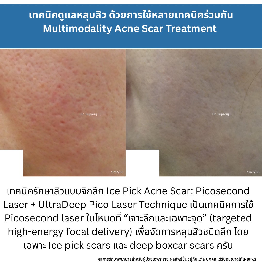 ทำไมต้องใช้เลเซอร์หลายชนิดในการรักษาหลุมสิว แผลเป็น รอยแตกลาย ? Why Combination Laser Therapy Is Essential for Treating Acne Scars, Scars, and Stretch Marks