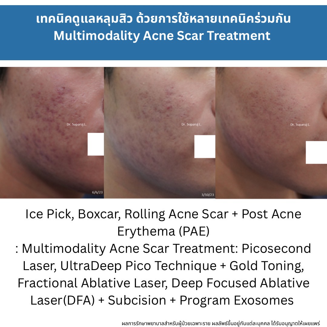ทำไมต้องใช้เลเซอร์หลายชนิดในการรักษาหลุมสิว แผลเป็น รอยแตกลาย ? Why Combination Laser Therapy Is Essential for Treating Acne Scars, Scars, and Stretch Marks ทำไมต้องใช้เลเซอร์หลายชนิดในการรักษาหลุมสิว แผลเป็น รอยแตกลาย ? Why Combination Laser Therapy Is Essential for Treating Acne Scars, Scars, and Stretch Marks
