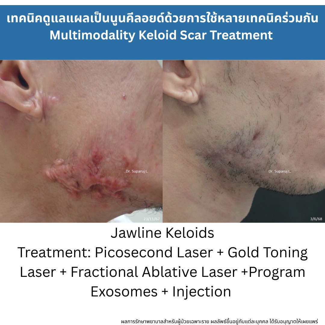 ทำไมต้องใช้เลเซอร์หลายชนิดในการรักษาหลุมสิว แผลเป็น รอยแตกลาย ? Why Combination Laser Therapy Is Essential for Treating Acne Scars, Scars, and Stretch Marks