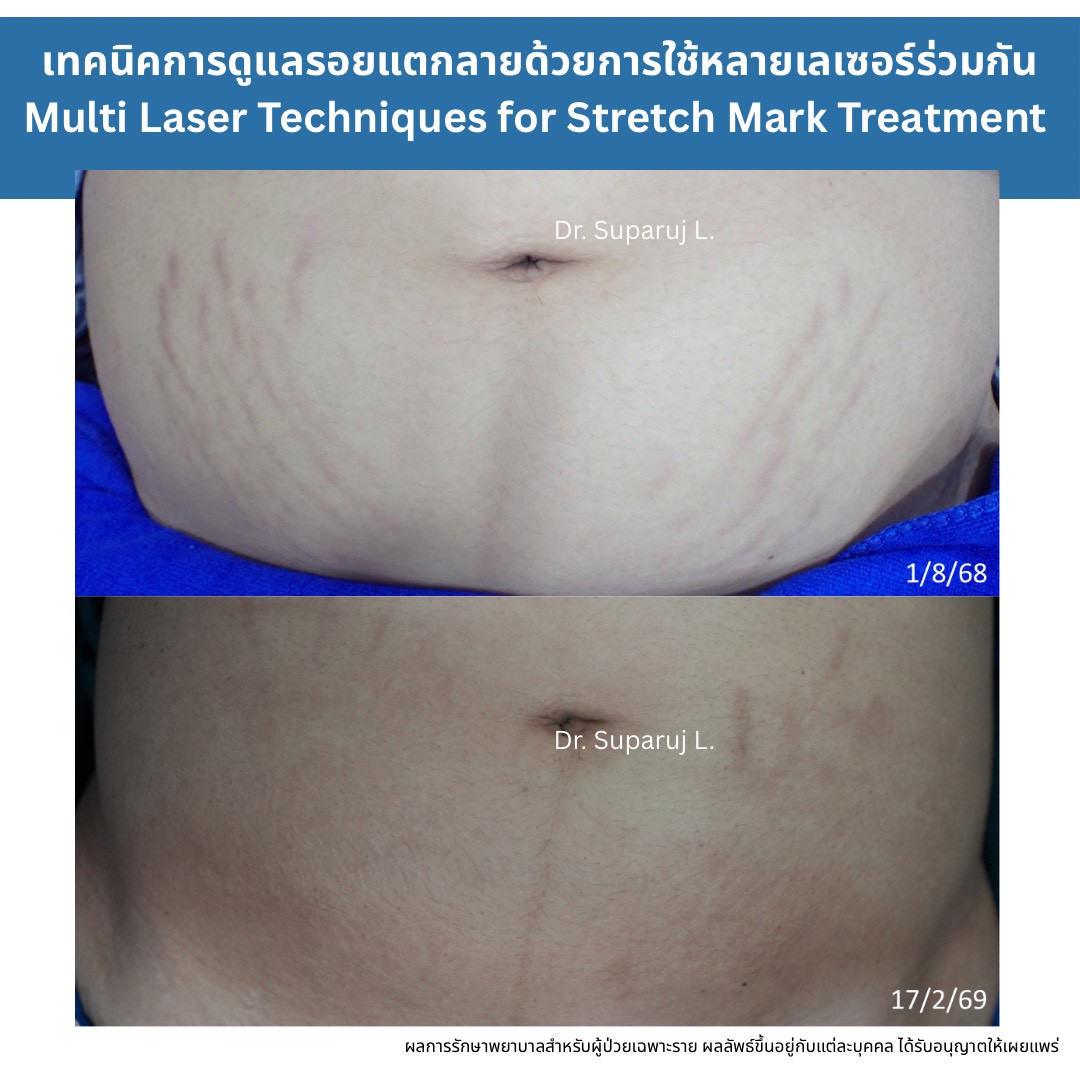 ทำไมต้องใช้เลเซอร์หลายชนิดในการรักษาหลุมสิว แผลเป็น รอยแตกลาย ? Why Combination Laser Therapy Is Essential for Treating Acne Scars, Scars, and Stretch Marks ทำไมต้องใช้เลเซอร์หลายชนิดในการรักษาหลุมสิว แผลเป็น รอยแตกลาย ? Why Combination Laser Therapy Is Essential for Treating Acne Scars, Scars, and Stretch Marks