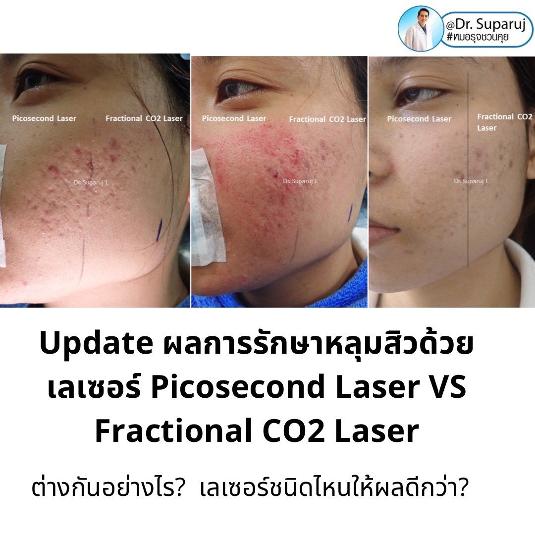 เจาะลึกความแตกต่าง: Fractional CO2 vs Fractional Picosecond Laser ในการรักษาหลุมสิว