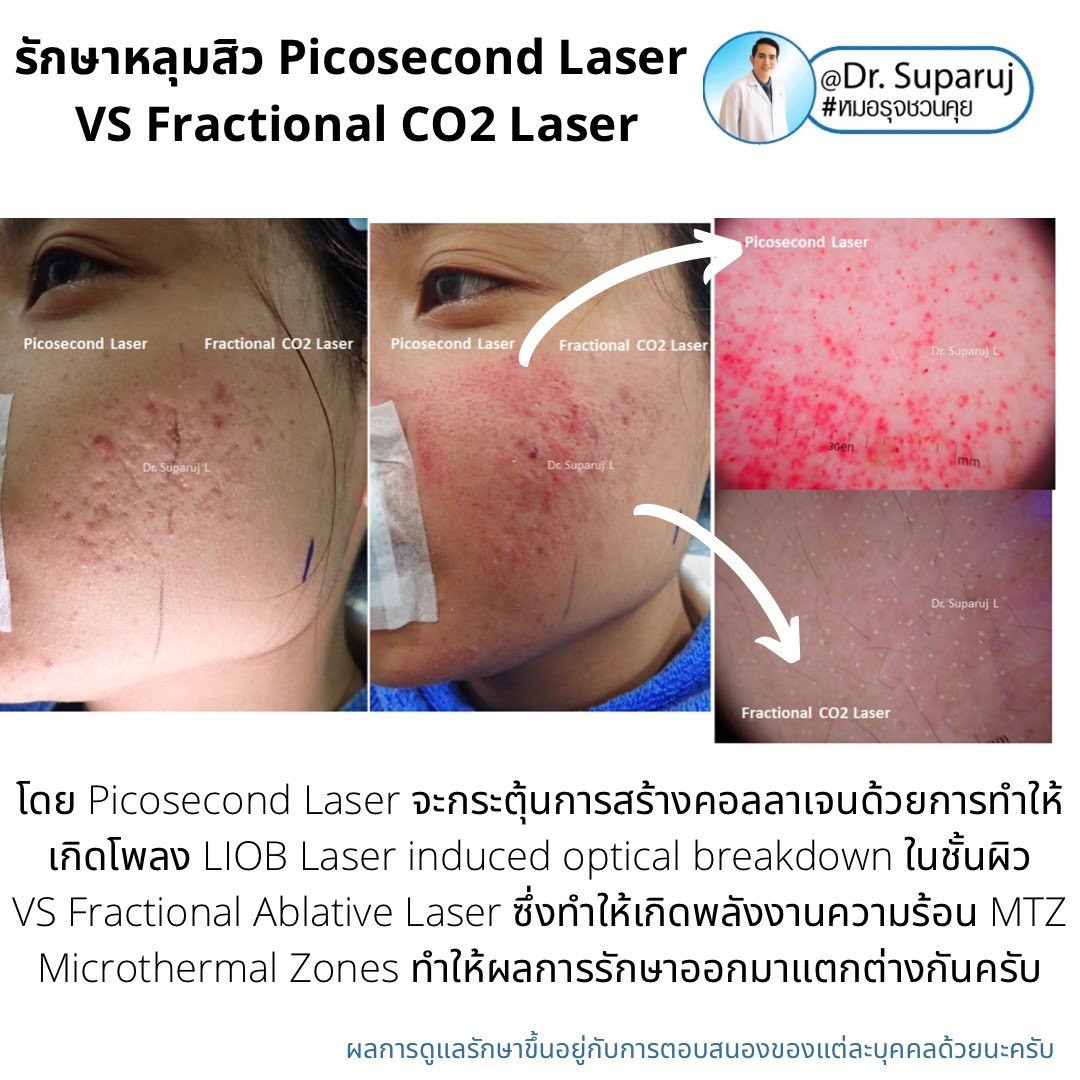 เจาะลึกความแตกต่าง: Fractional CO2 vs Fractional Picosecond Laser ในการรักษาหลุมสิว