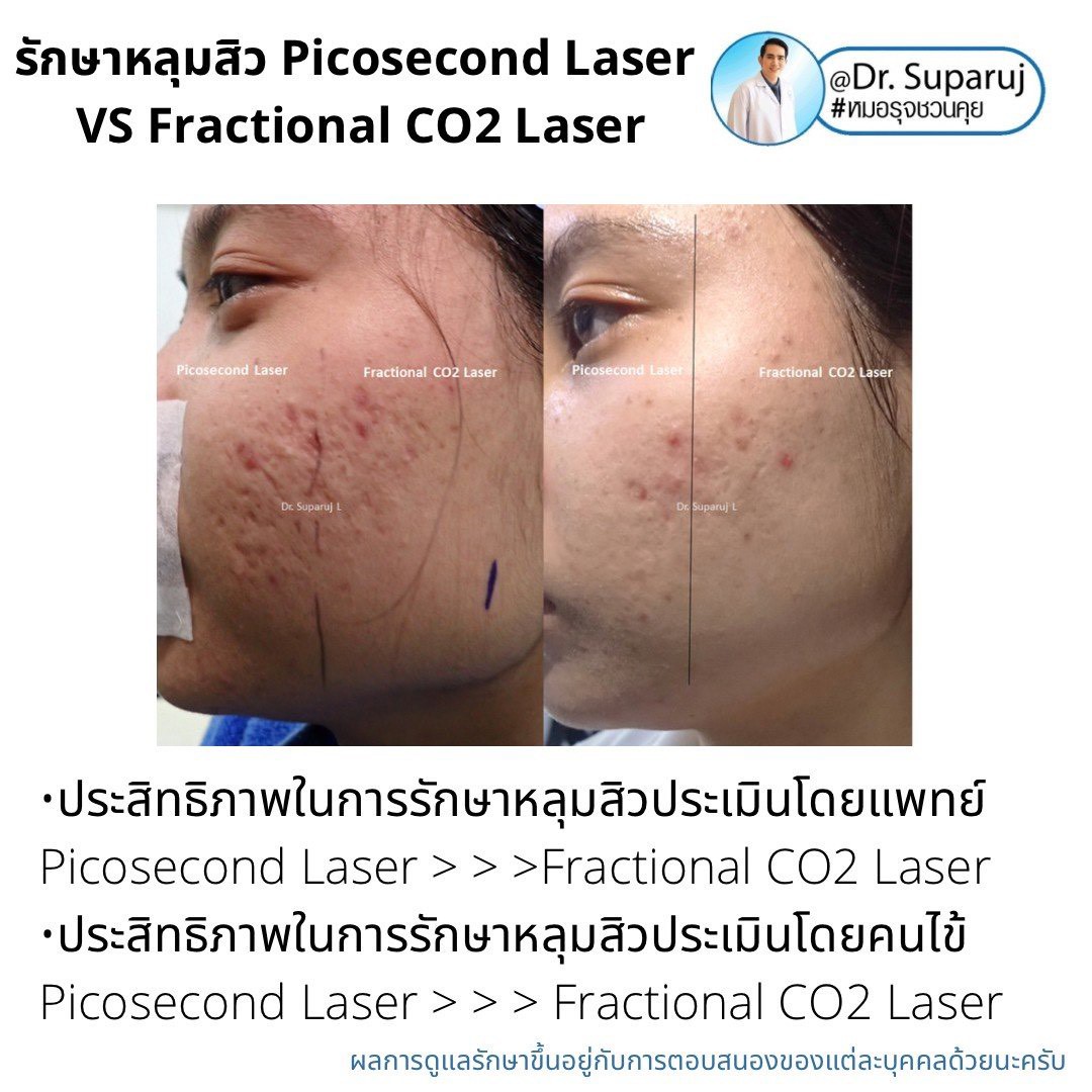 เจาะลึกความแตกต่าง: Fractional CO2 vs Fractional Picosecond Laser ในการรักษาหลุมสิว