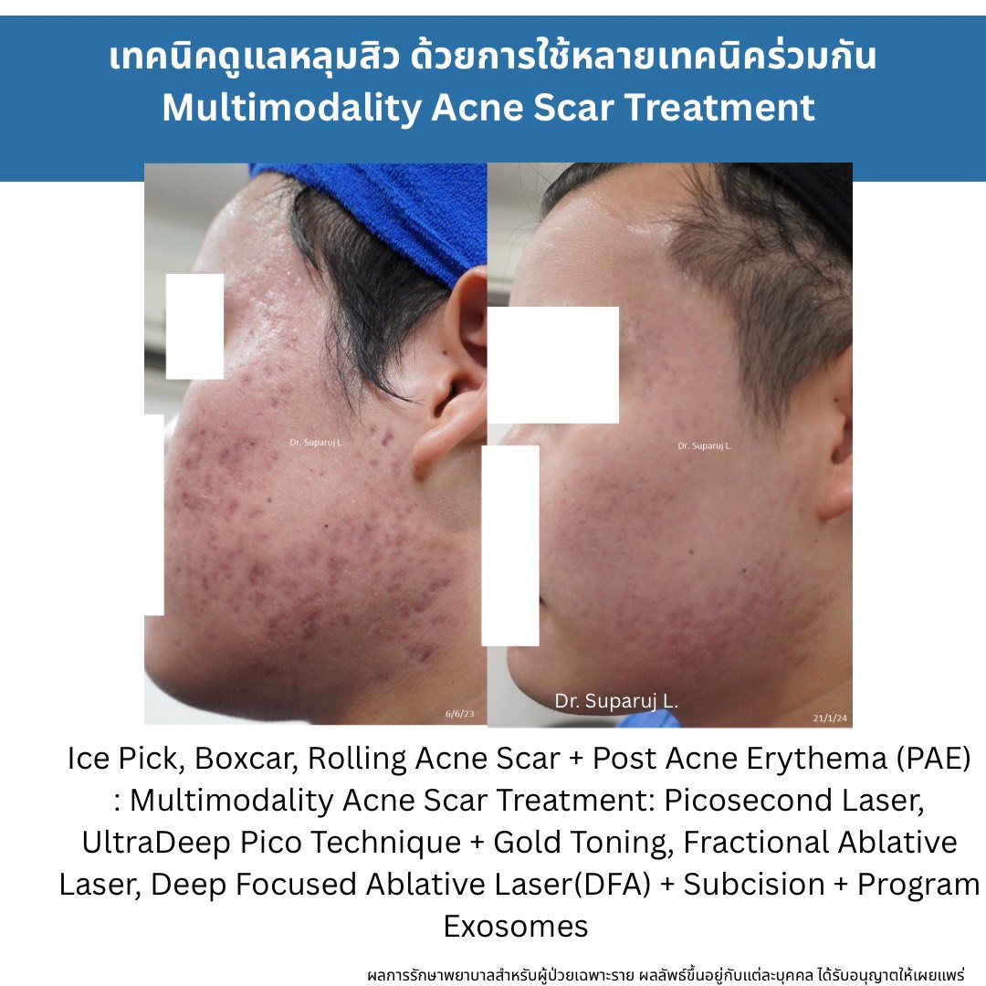 รักษาหลุมสิวแต่พักหน้าไม่ได้ มีวิธีอะไรบ้าง ? How to Treat Acne Scars When You Can’t Afford a Recovery Period แนวทางการรักษาหลุมสิวสำหรับผู้ที่ไม่สามารถพักหน้าได้ (Social Down-time Limited)ครับ.